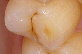 犬歯、小臼歯の象牙質露出