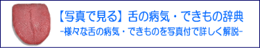 写真で見る！舌の病気・できもの辞典