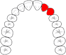 ブリッジ欠損1