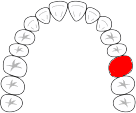 ブリッジ欠損3