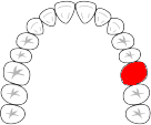 ブリッジ欠損３