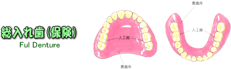 総入れ歯(保険)