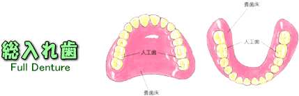 総入れ歯　Full Denture