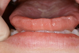 舌の圧痕１