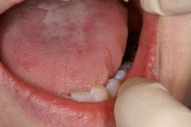 舌の圧痕２