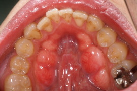 下顎舌側の骨隆起