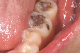 大臼歯咬合面のディンプル (溝)