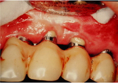 頬側骨隆起 (下顎)