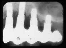 下顎舌側の骨隆起