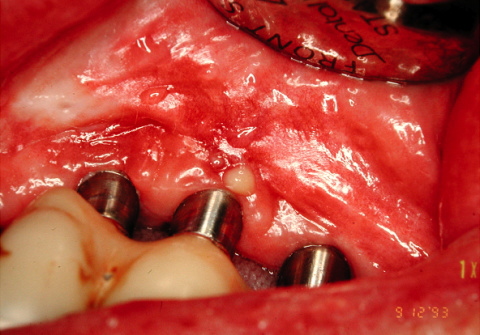 マイクロクラック (歯のヒビ)