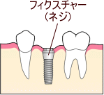 インプラント　フィクスチャー