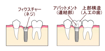 インプラント1