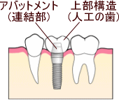インプラント アバットメント