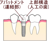 インプラント　アバットメント