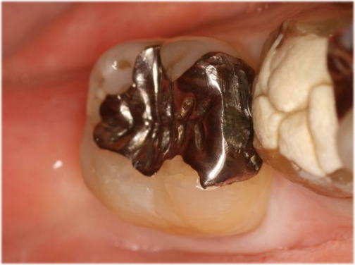 保険のメタルインレー(銀の詰め物)