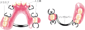 部分床義歯(部分入れ歯)