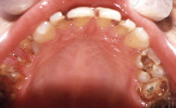 虫歯・齲蝕(う蝕)caries、dental caries、carious tooth、decayed tooth