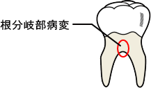 根分岐部病変