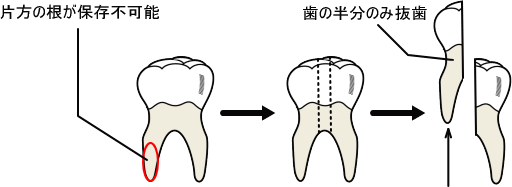 ヘミセクション