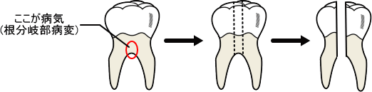 ルートセパレーション(歯根分割術)