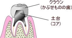 支台築造画像