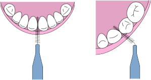 歯間ブラシ