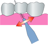 歯間ブラシ(ブリッジ下部の清掃)