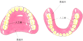 全部床義歯(総入れ歯)