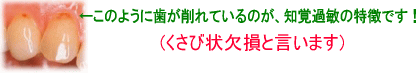 このように歯が削れているのが、知覚過敏の特徴です！