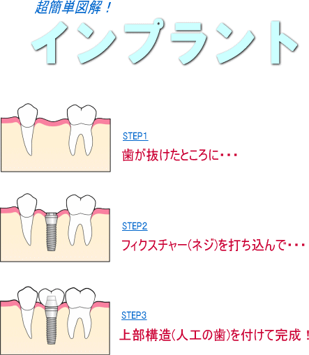 インプラント