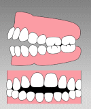 開口(前歯が噛まない)