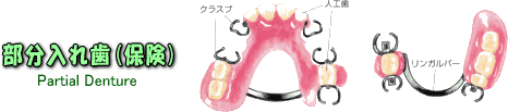 部分入れ歯(保険)