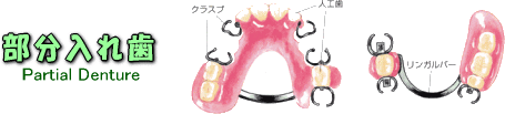 部分入れ歯