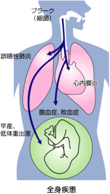 歯周病と全身疾患