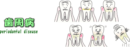 歯周病（歯槽膿漏）