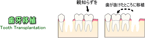 歯牙移植